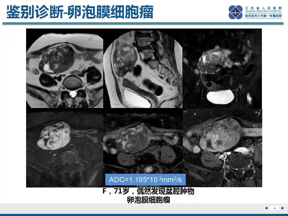 影像PPT - 【PPT】卵巢环状小管性索肿瘤-43