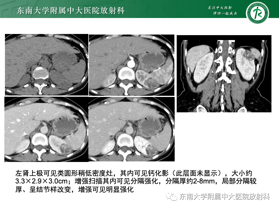 影像PPT - 【PPT】囊性肾癌-3