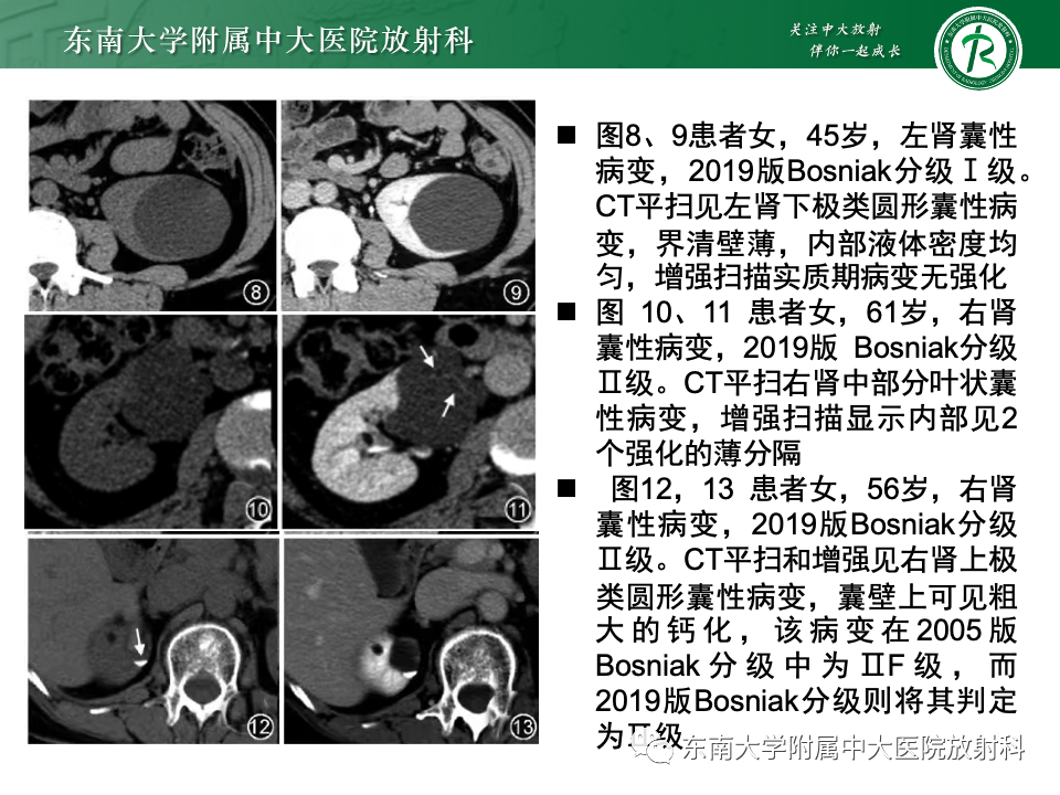 影像PPT - 【PPT】囊性肾癌-19