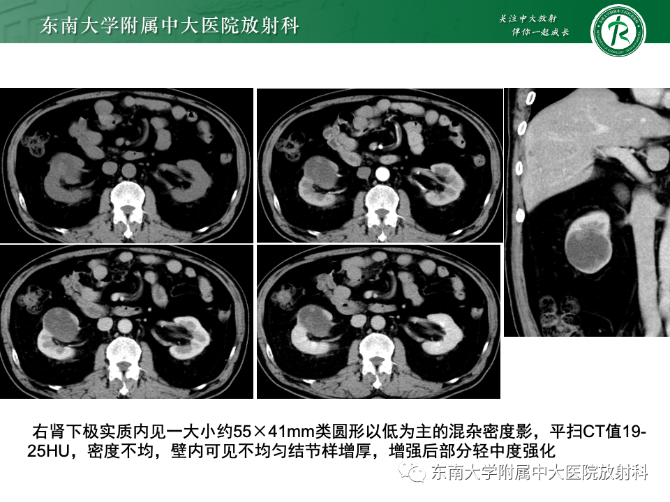 影像PPT - 【PPT】囊性肾癌-22