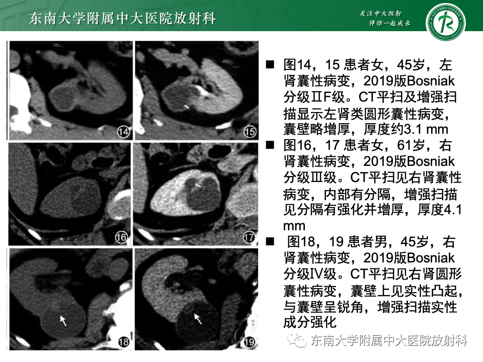 影像PPT - 【PPT】囊性肾癌-20