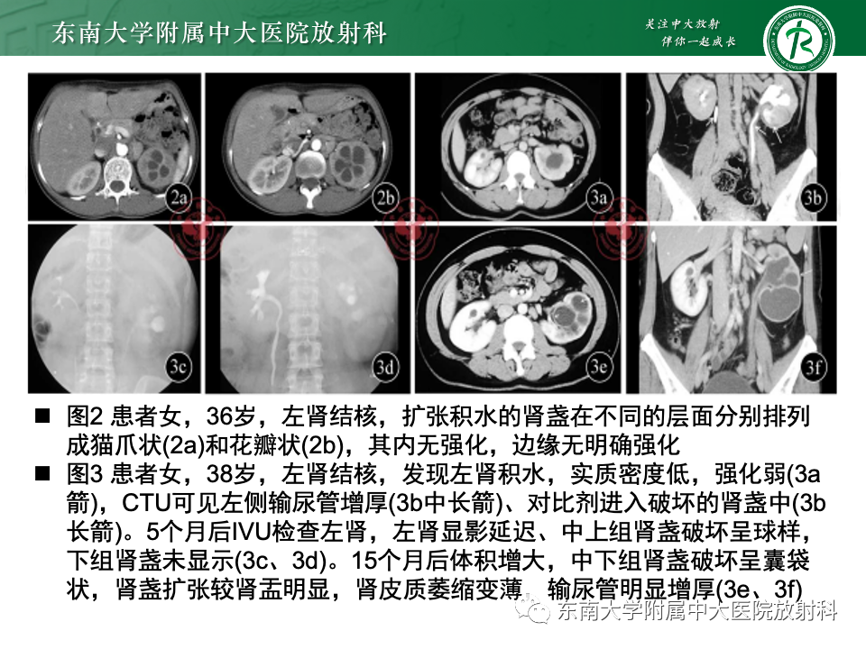 影像PPT - 【PPT】囊性肾癌-28