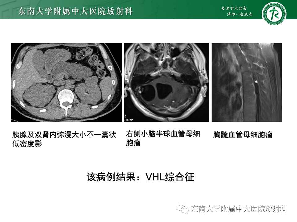 影像PPT - 【PPT】囊性肾癌-37