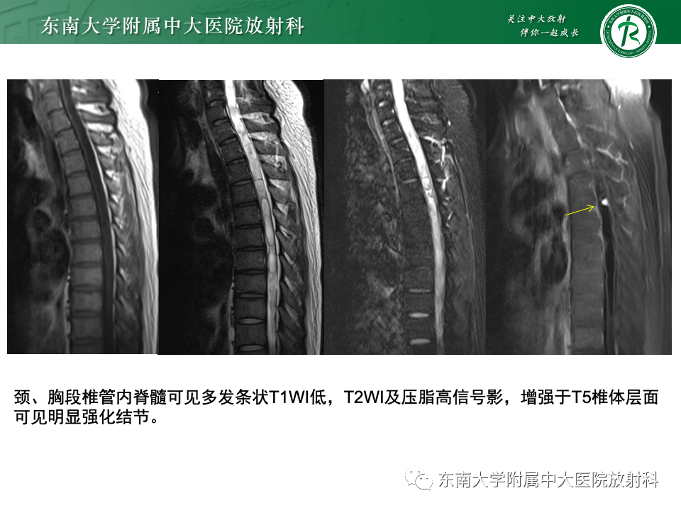 影像PPT - 【PPT】囊性肾癌-36