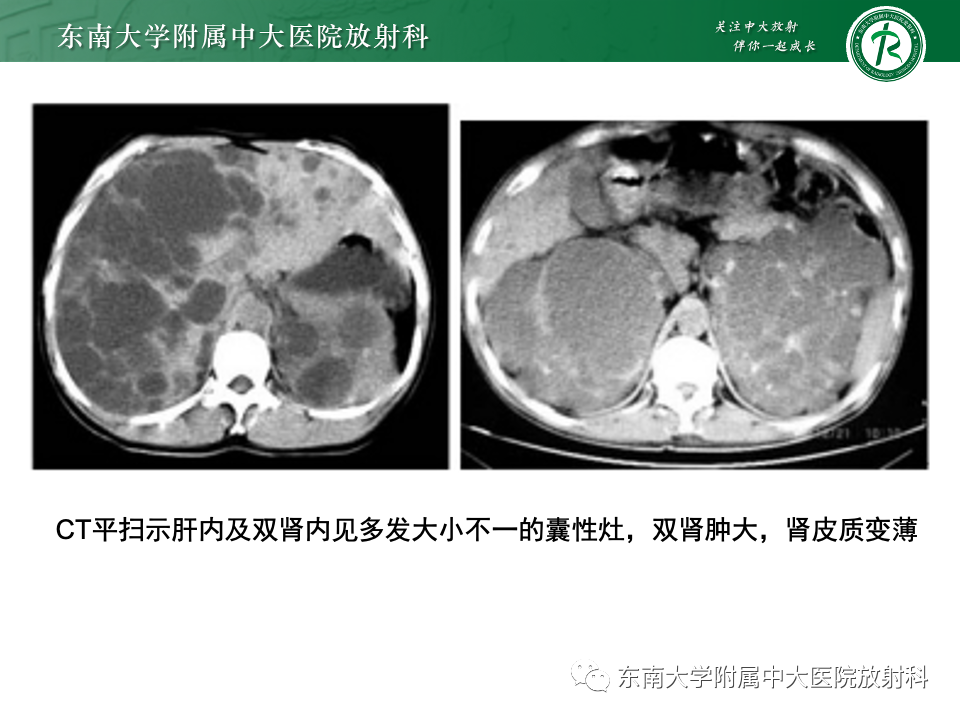 影像PPT - 【PPT】囊性肾癌-41