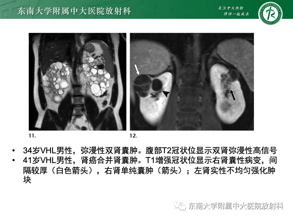 影像PPT - 【PPT】囊性肾癌-39