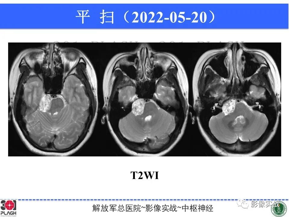 影像PPT - 【病例】桥小脑角区神经鞘瘤1例CT及MR影像-5