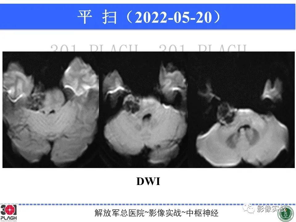影像PPT - 【病例】桥小脑角区神经鞘瘤1例CT及MR影像-7