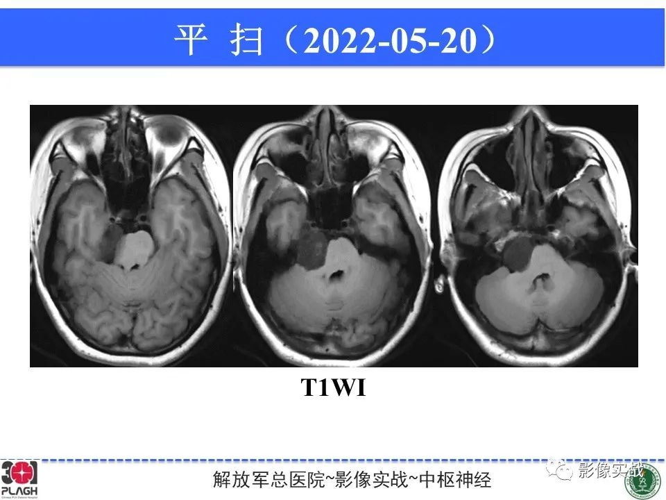 影像PPT - 【病例】桥小脑角区神经鞘瘤1例CT及MR影像-6
