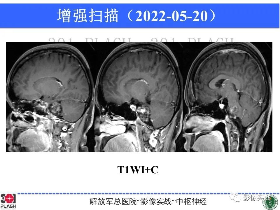 影像PPT - 【病例】桥小脑角区神经鞘瘤1例CT及MR影像-12