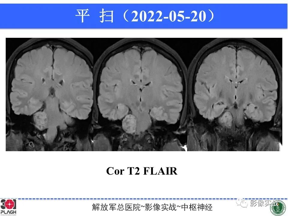 影像PPT - 【病例】桥小脑角区神经鞘瘤1例CT及MR影像-9