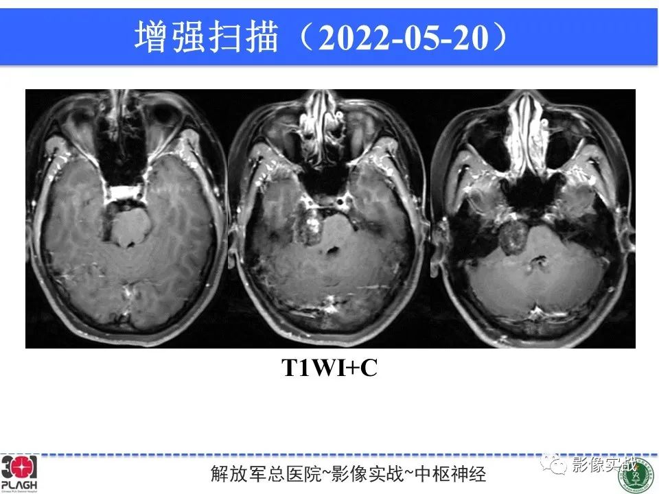影像PPT - 【病例】桥小脑角区神经鞘瘤1例CT及MR影像-10