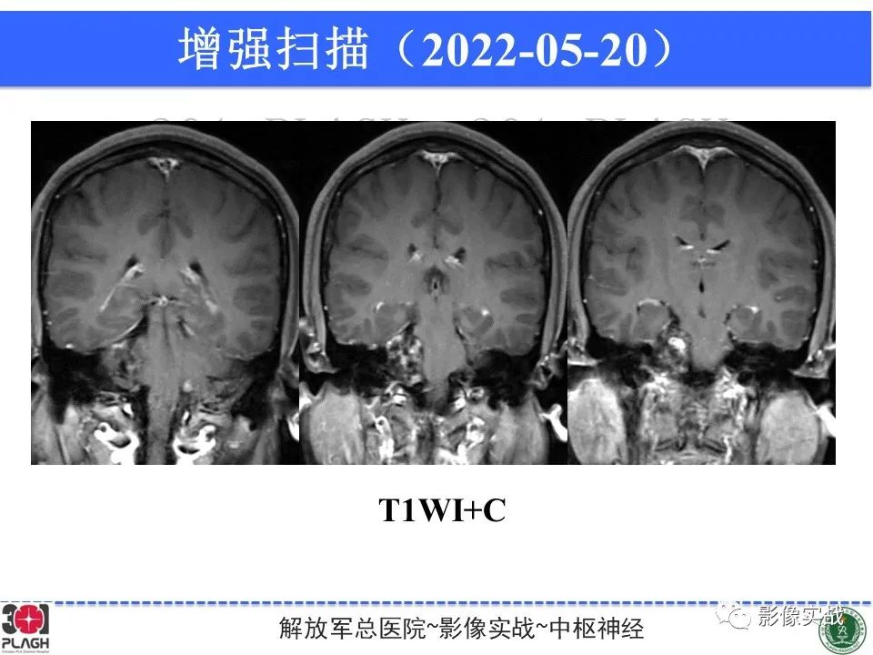 影像PPT - 【病例】桥小脑角区神经鞘瘤1例CT及MR影像-11