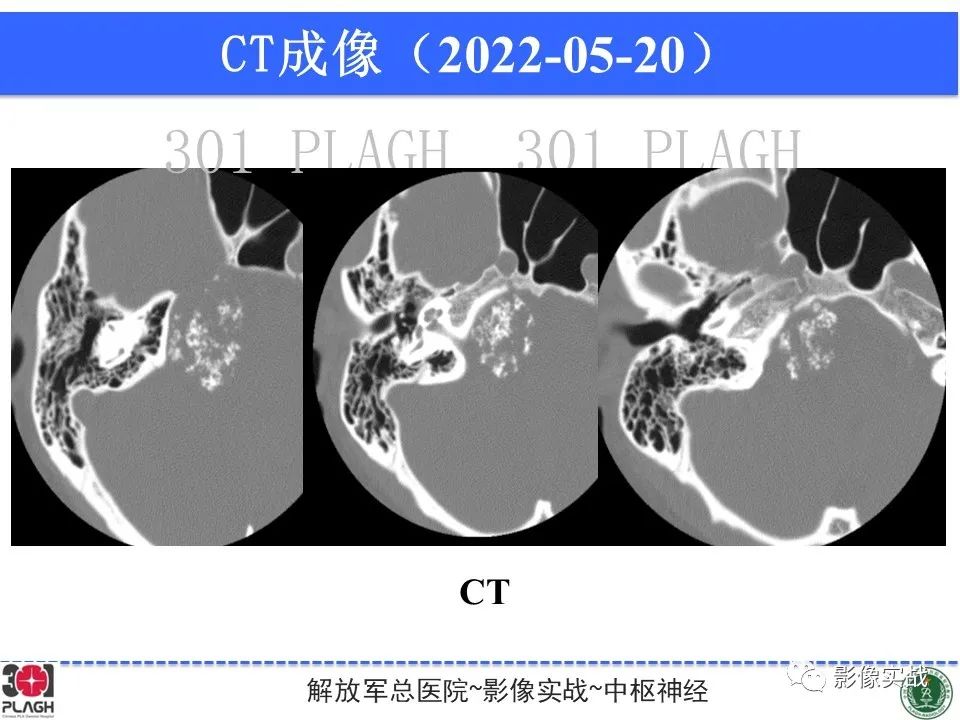 影像PPT - 【病例】桥小脑角区神经鞘瘤1例CT及MR影像-13