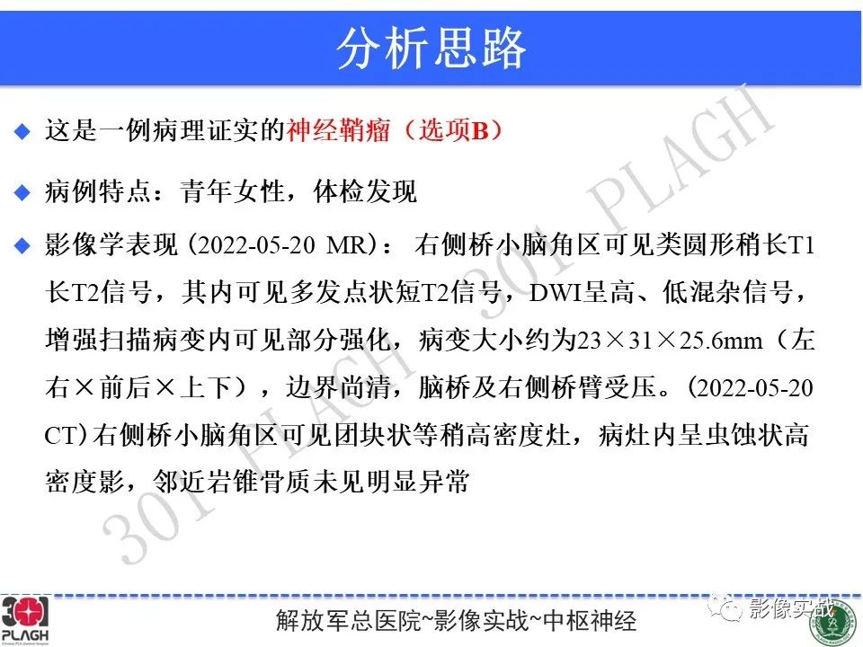 影像PPT - 【病例】桥小脑角区神经鞘瘤1例CT及MR影像-15