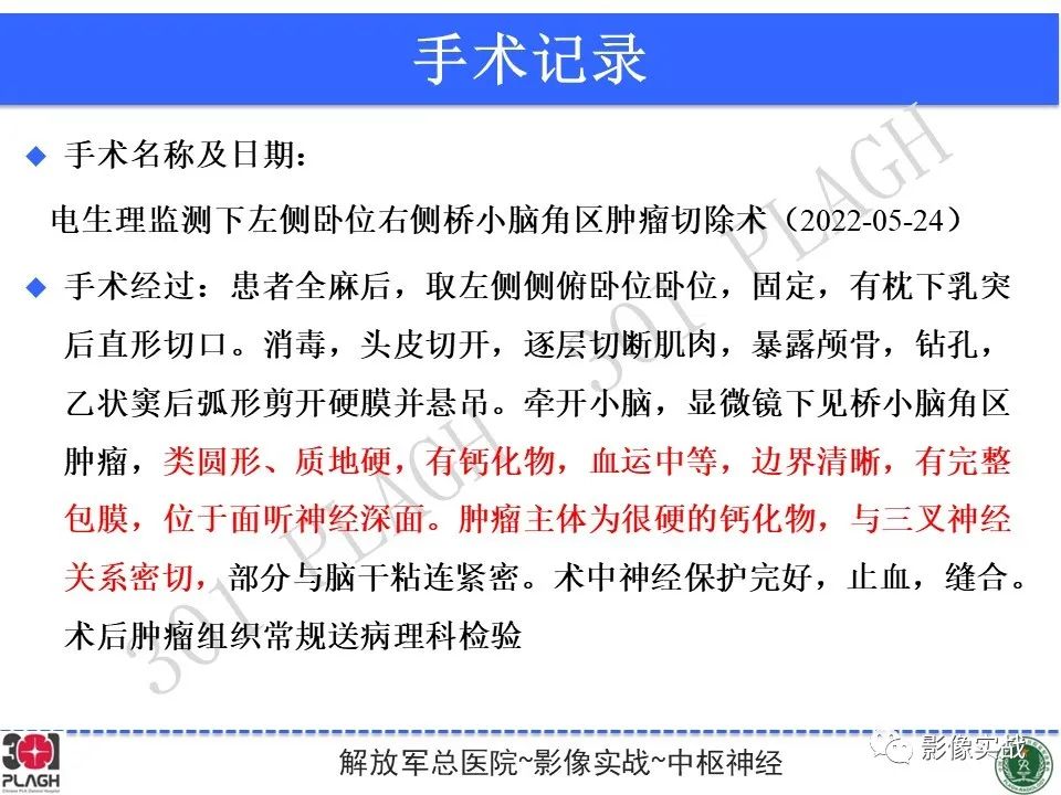 影像PPT - 【病例】桥小脑角区神经鞘瘤1例CT及MR影像-20
