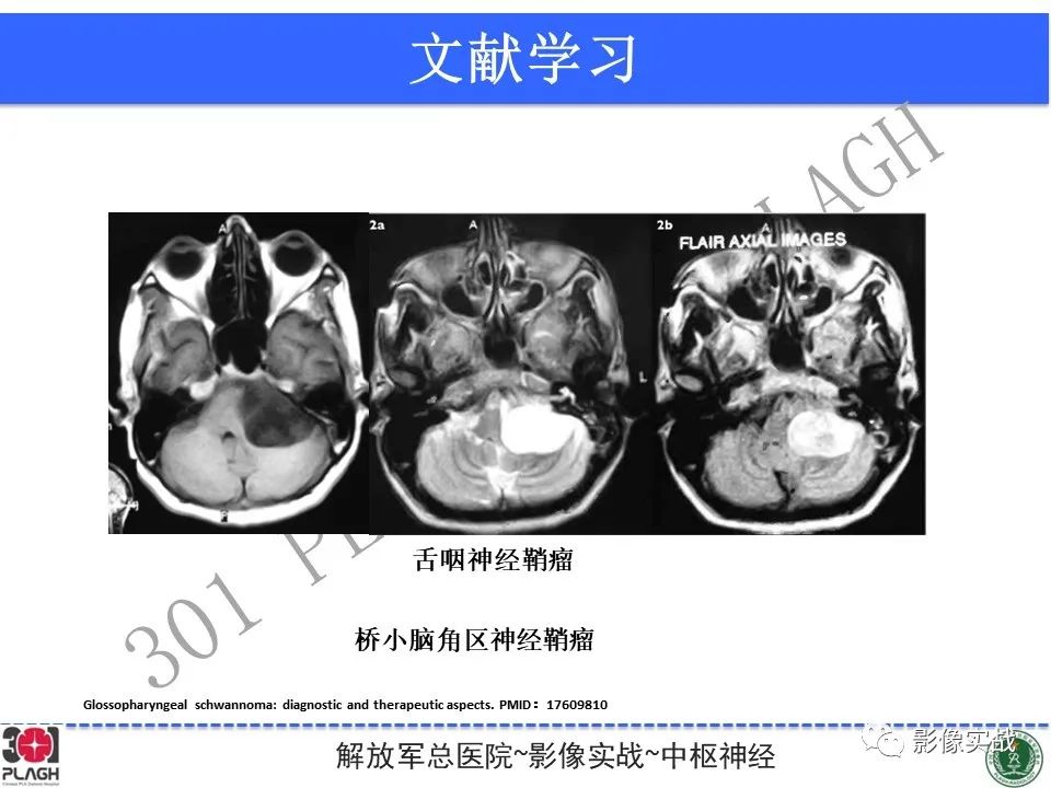 影像PPT - 【病例】桥小脑角区神经鞘瘤1例CT及MR影像-25
