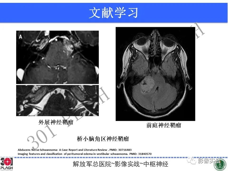 影像PPT - 【病例】桥小脑角区神经鞘瘤1例CT及MR影像-24