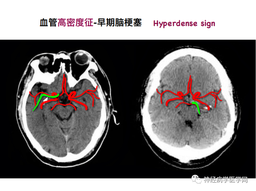 影像PPT - 【PPT】特征性异常脑影像荟萃(手绘重置版)-7