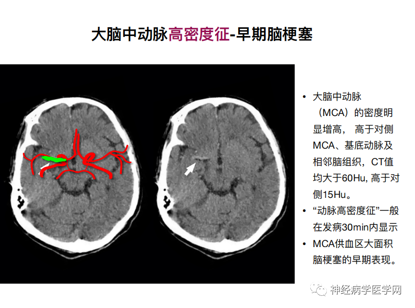 影像PPT - 【PPT】特征性异常脑影像荟萃(手绘重置版)-8