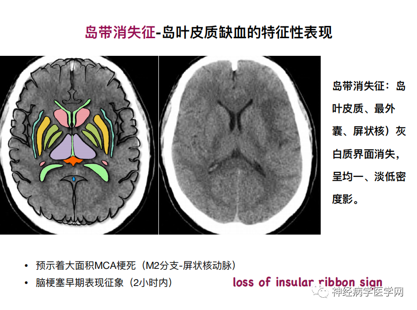 影像PPT - 【PPT】特征性异常脑影像荟萃(手绘重置版)-10