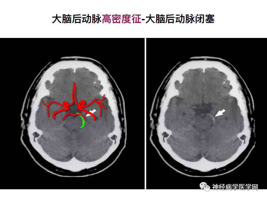 影像PPT - 【PPT】特征性异常脑影像荟萃(手绘重置版)-9