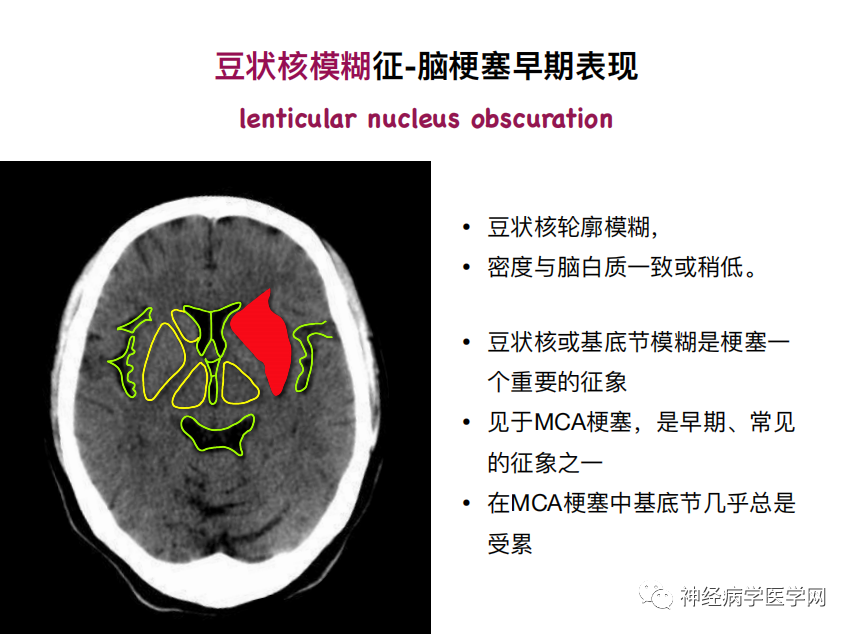 影像PPT - 【PPT】特征性异常脑影像荟萃(手绘重置版)-12