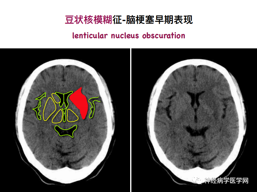 影像PPT - 【PPT】特征性异常脑影像荟萃(手绘重置版)-13
