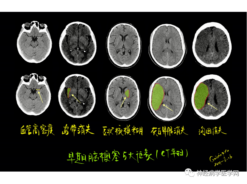 影像PPT - 【PPT】特征性异常脑影像荟萃(手绘重置版)-15
