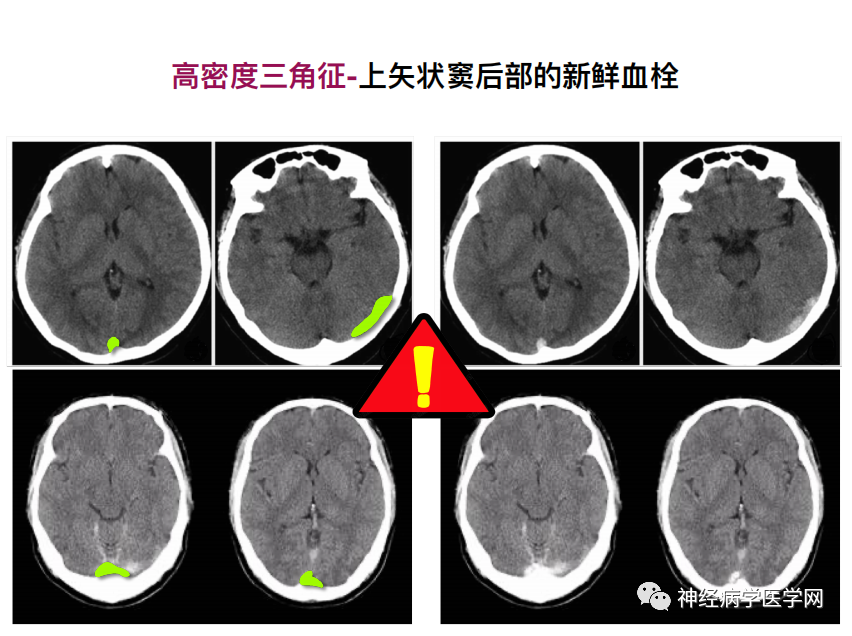 影像PPT - 【PPT】特征性异常脑影像荟萃(手绘重置版)-17