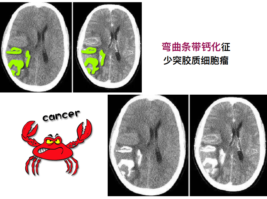 影像PPT - 【PPT】特征性异常脑影像荟萃(手绘重置版)-19