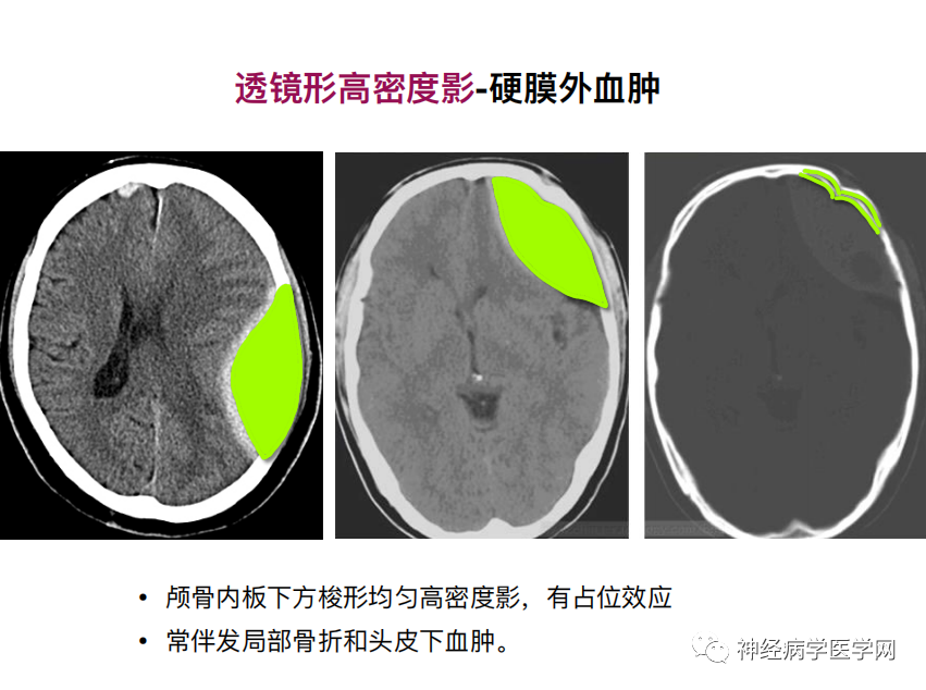 影像PPT - 【PPT】特征性异常脑影像荟萃(手绘重置版)-20