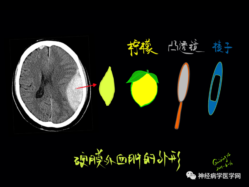 影像PPT - 【PPT】特征性异常脑影像荟萃(手绘重置版)-22