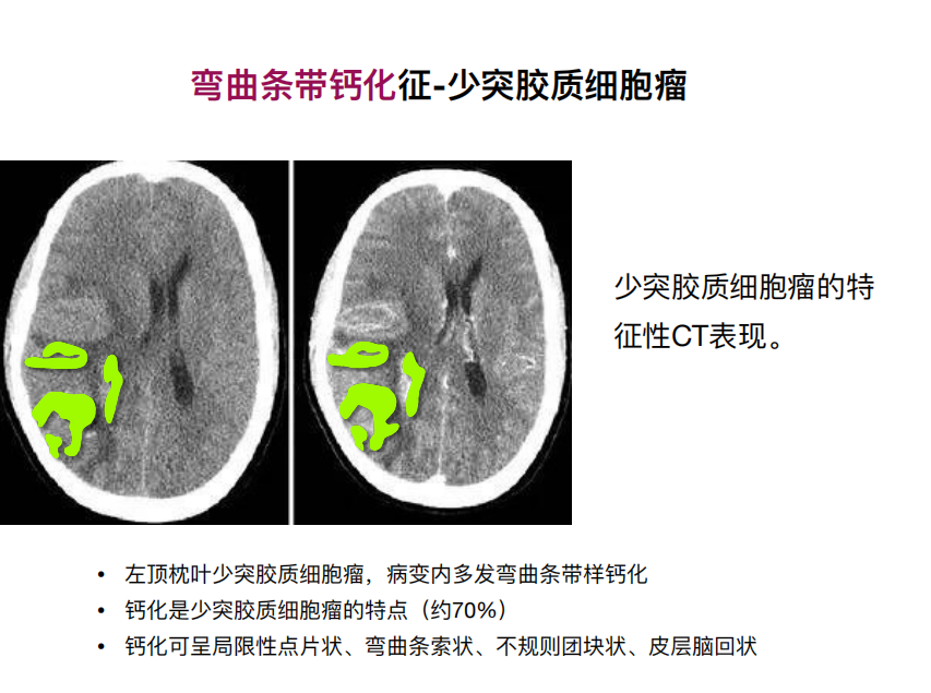 影像PPT - 【PPT】特征性异常脑影像荟萃(手绘重置版)-18