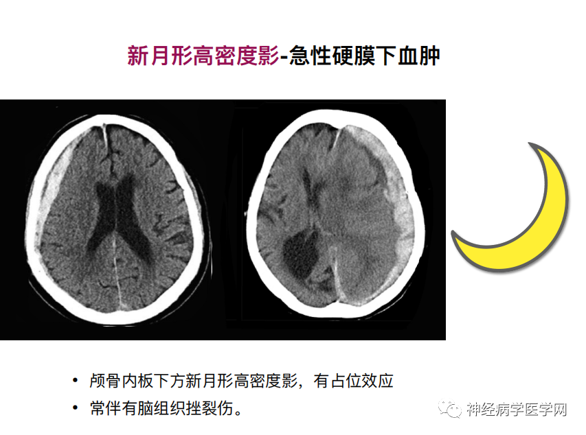 影像PPT - 【PPT】特征性异常脑影像荟萃(手绘重置版)-23