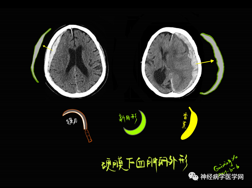 影像PPT - 【PPT】特征性异常脑影像荟萃(手绘重置版)-25