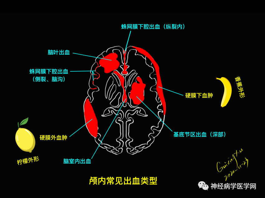 影像PPT - 【PPT】特征性异常脑影像荟萃(手绘重置版)-26