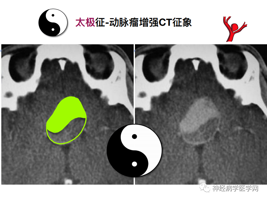 影像PPT - 【PPT】特征性异常脑影像荟萃(手绘重置版)-29