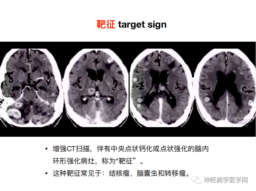 影像PPT - 【PPT】特征性异常脑影像荟萃(手绘重置版)-31