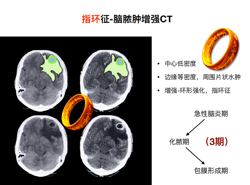 影像PPT - 【PPT】特征性异常脑影像荟萃(手绘重置版)-34