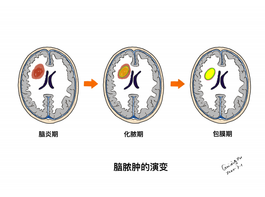 影像PPT - 【PPT】特征性异常脑影像荟萃(手绘重置版)-35