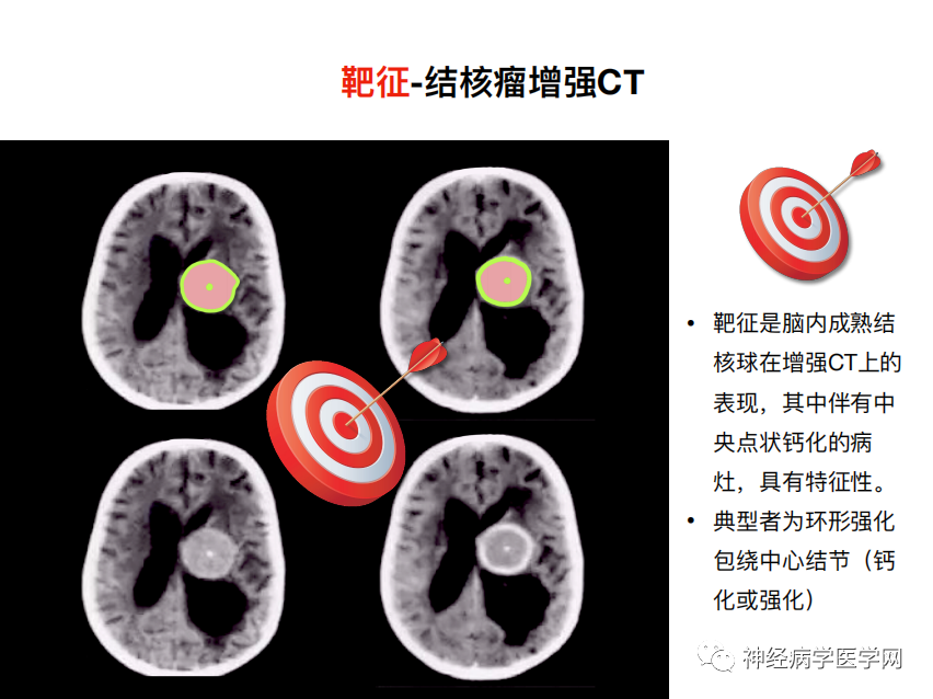 影像PPT - 【PPT】特征性异常脑影像荟萃(手绘重置版)-32
