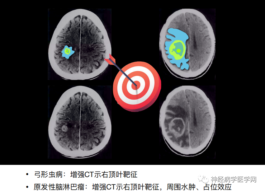 影像PPT - 【PPT】特征性异常脑影像荟萃(手绘重置版)-33