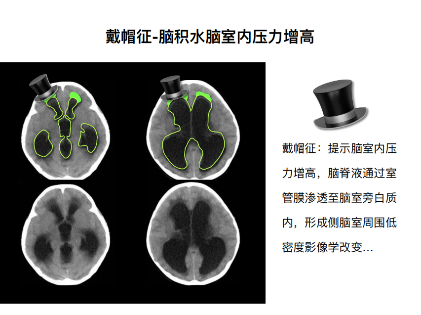 影像PPT - 【PPT】特征性异常脑影像荟萃(手绘重置版)-36
