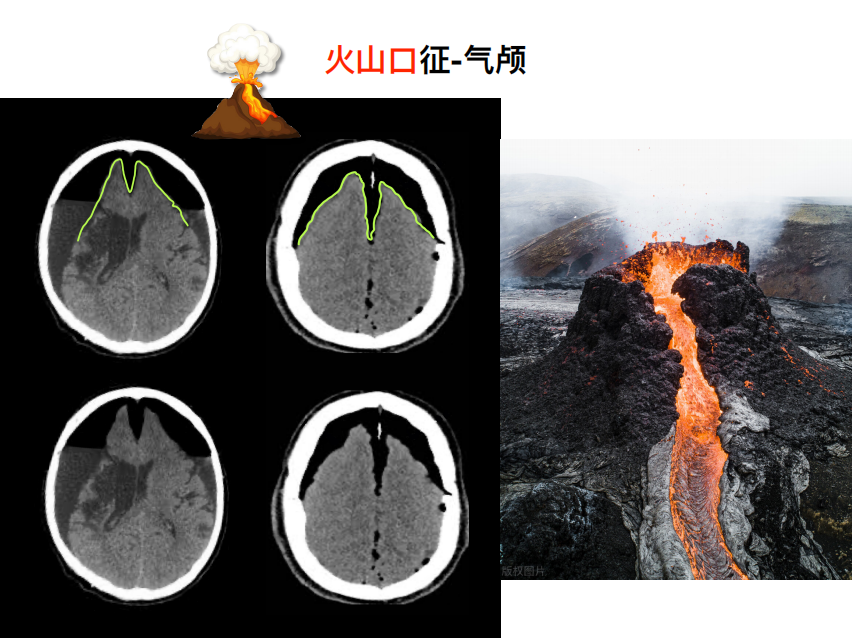 影像PPT - 【PPT】特征性异常脑影像荟萃(手绘重置版)-37