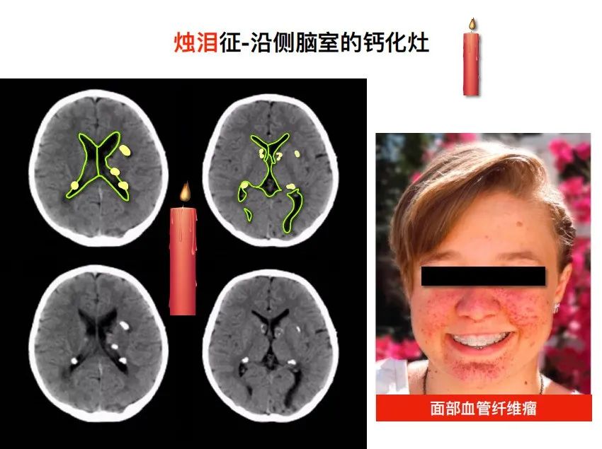 影像PPT - 【PPT】特征性异常脑影像荟萃(手绘重置版)-38