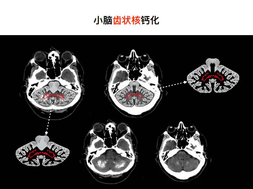 影像PPT - 【PPT】特征性异常脑影像荟萃(手绘重置版)-39