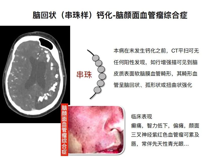 影像PPT - 【PPT】特征性异常脑影像荟萃(手绘重置版)-40