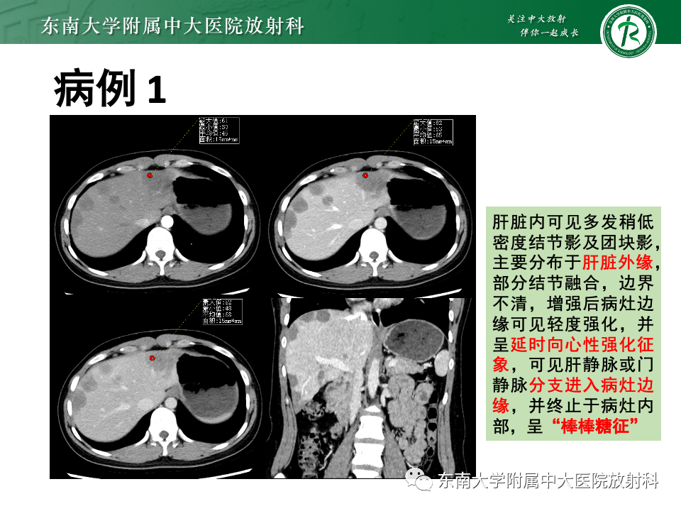 影像PPT - 【PPT】肝脏上皮样血管内皮瘤-3 影像PPT - 【PPT】肝脏上皮样血管内皮瘤-3