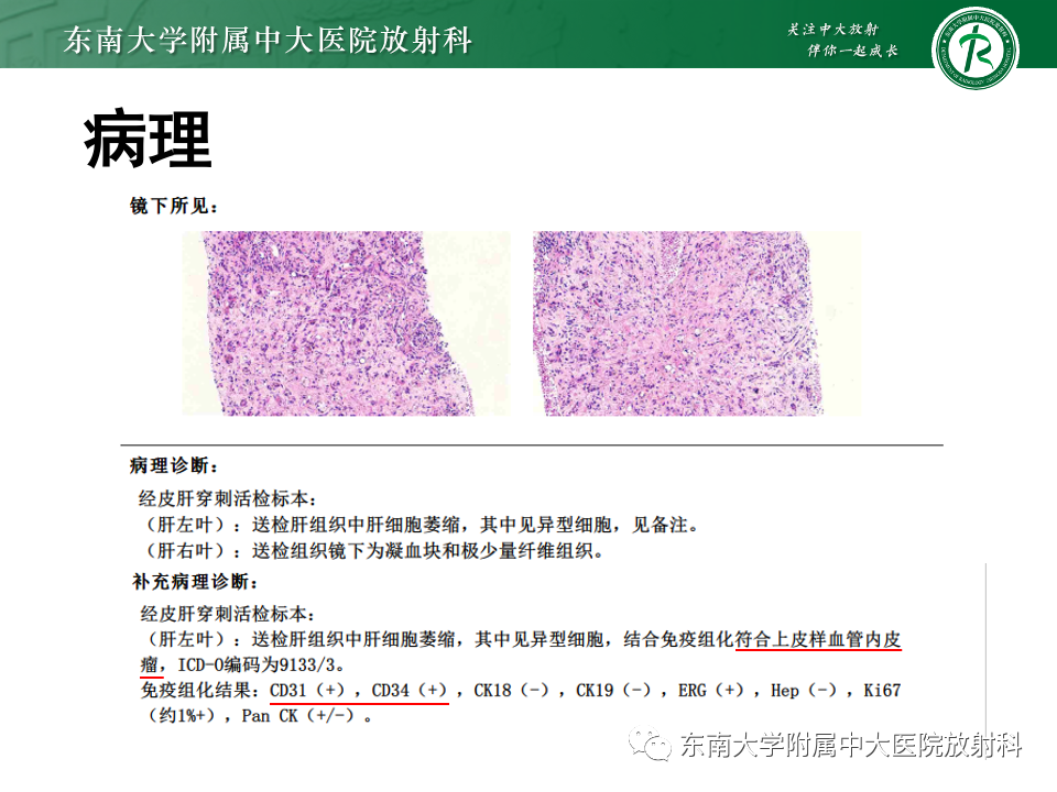 影像PPT - 【PPT】肝脏上皮样血管内皮瘤-4 影像PPT - 【PPT】肝脏上皮样血管内皮瘤-4